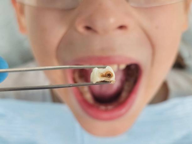 Best Cracked Tooth Emergency Dentist  in Mountain House, CA